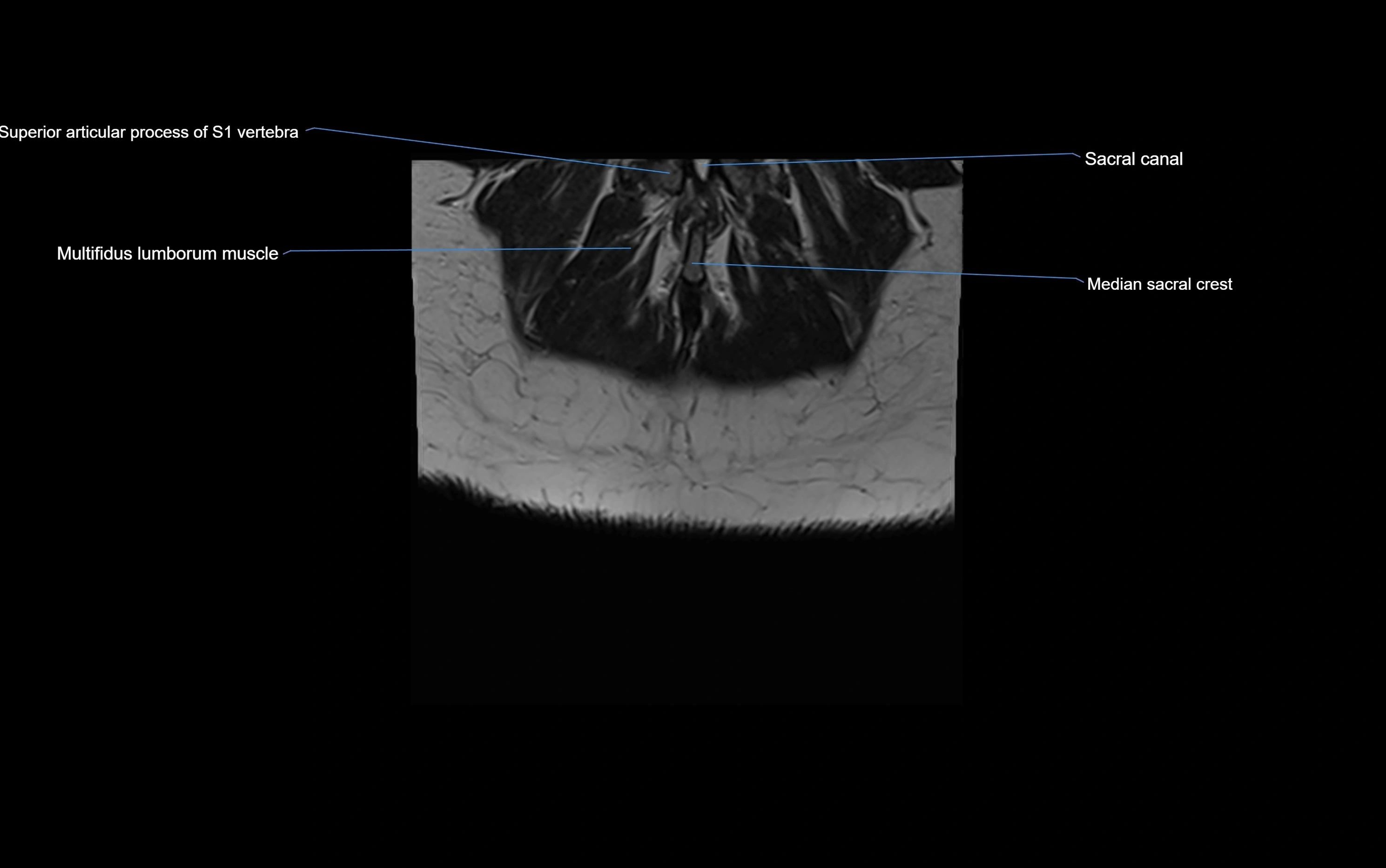 MRI sacroiliac joint coronal cross sectional anatomy  radiology  image-img-00001-00032.webp